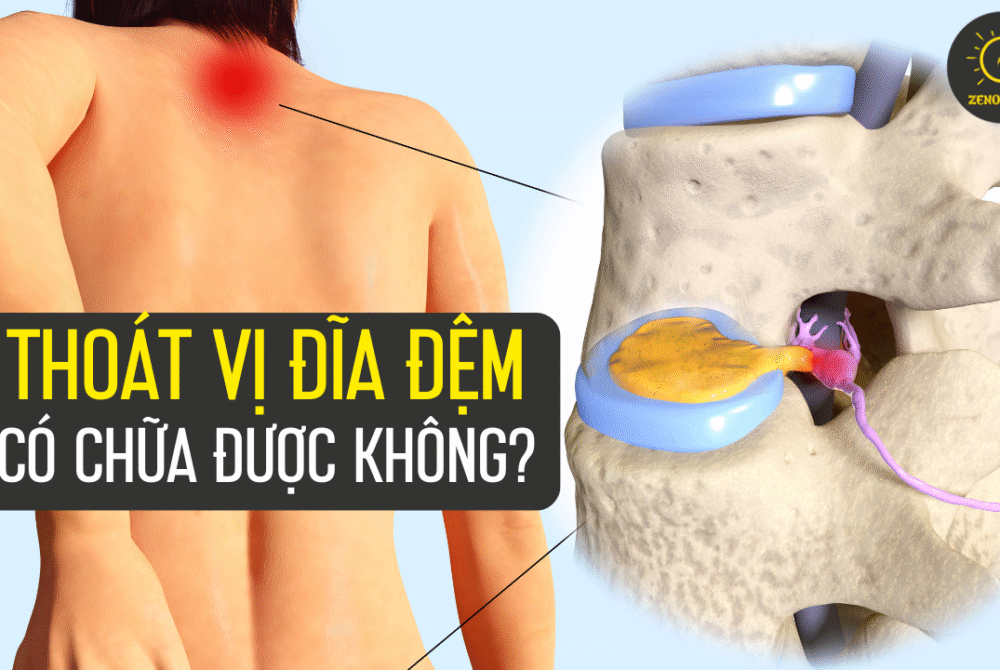 thoái vị đĩa đệm