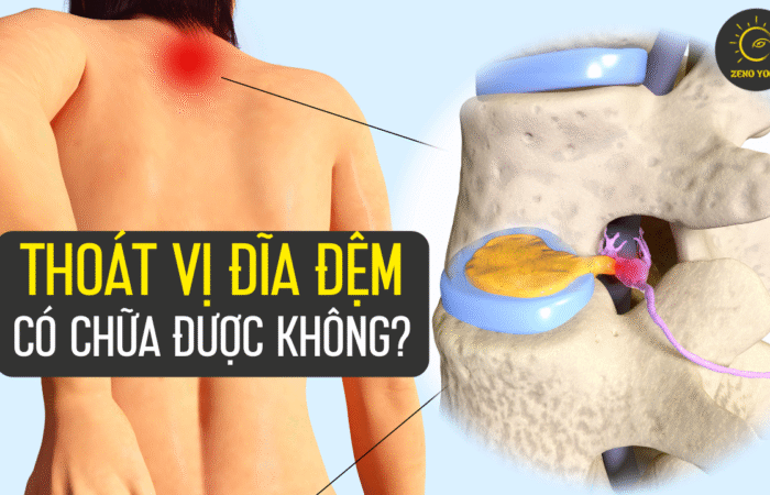 thoái vị đĩa đệm thoái vị đĩa đệm