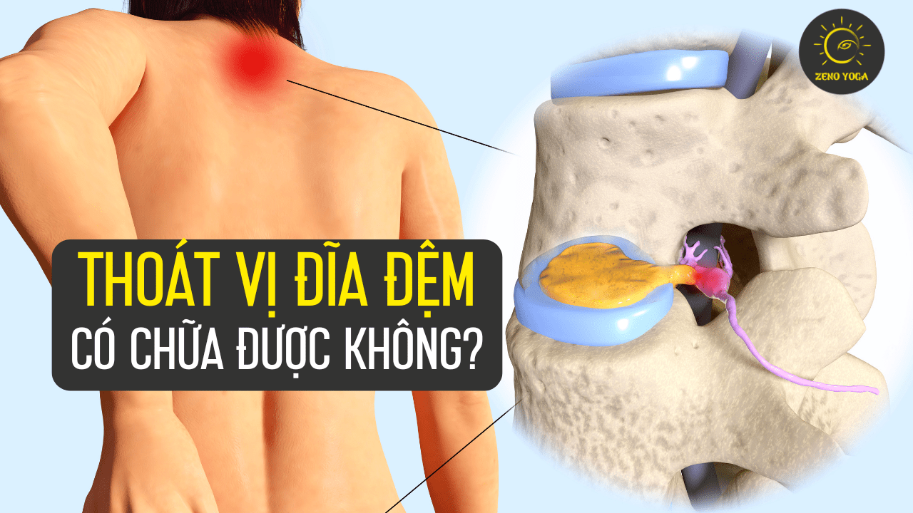 thoái vị đĩa đệm thoái vị đĩa đệm